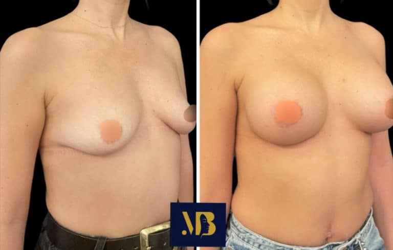 Augmentation mammaire par prothèse