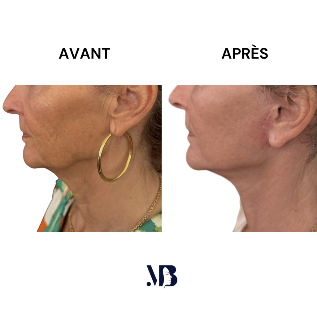 Le lifting du visage et du cou à Paris permet de retendre la peau du visage et du cou par la chirurgie de manière naturelle.