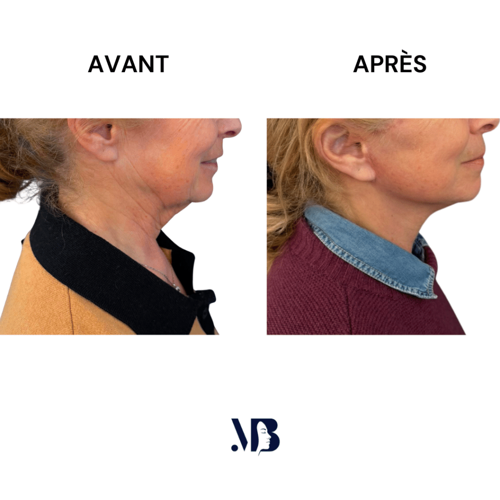 Le lifting du visage