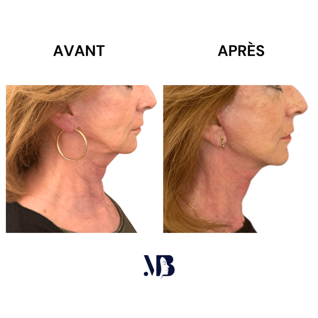 Le lifting du visage et du cou à Paris permet de retendre la peau du visage et du cou par la chirurgie de manière naturelle.