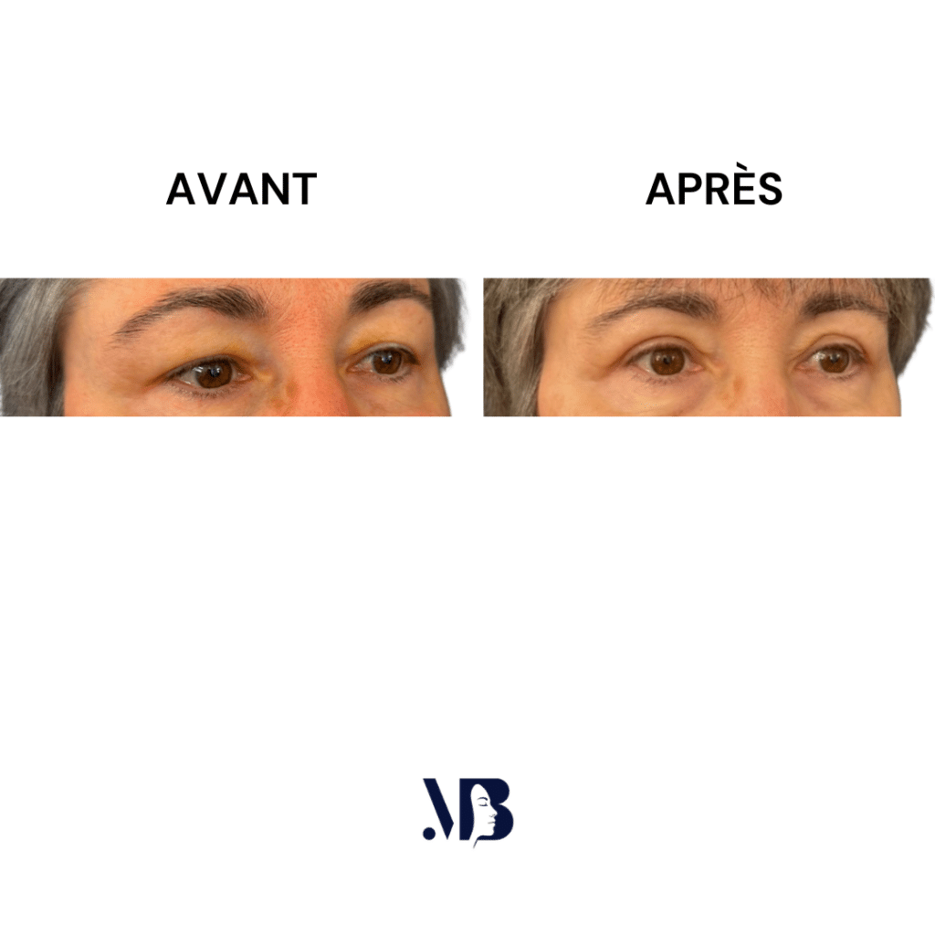 La blépharoplastie supérieure est la chirurgie esthétique des paupières tombante.