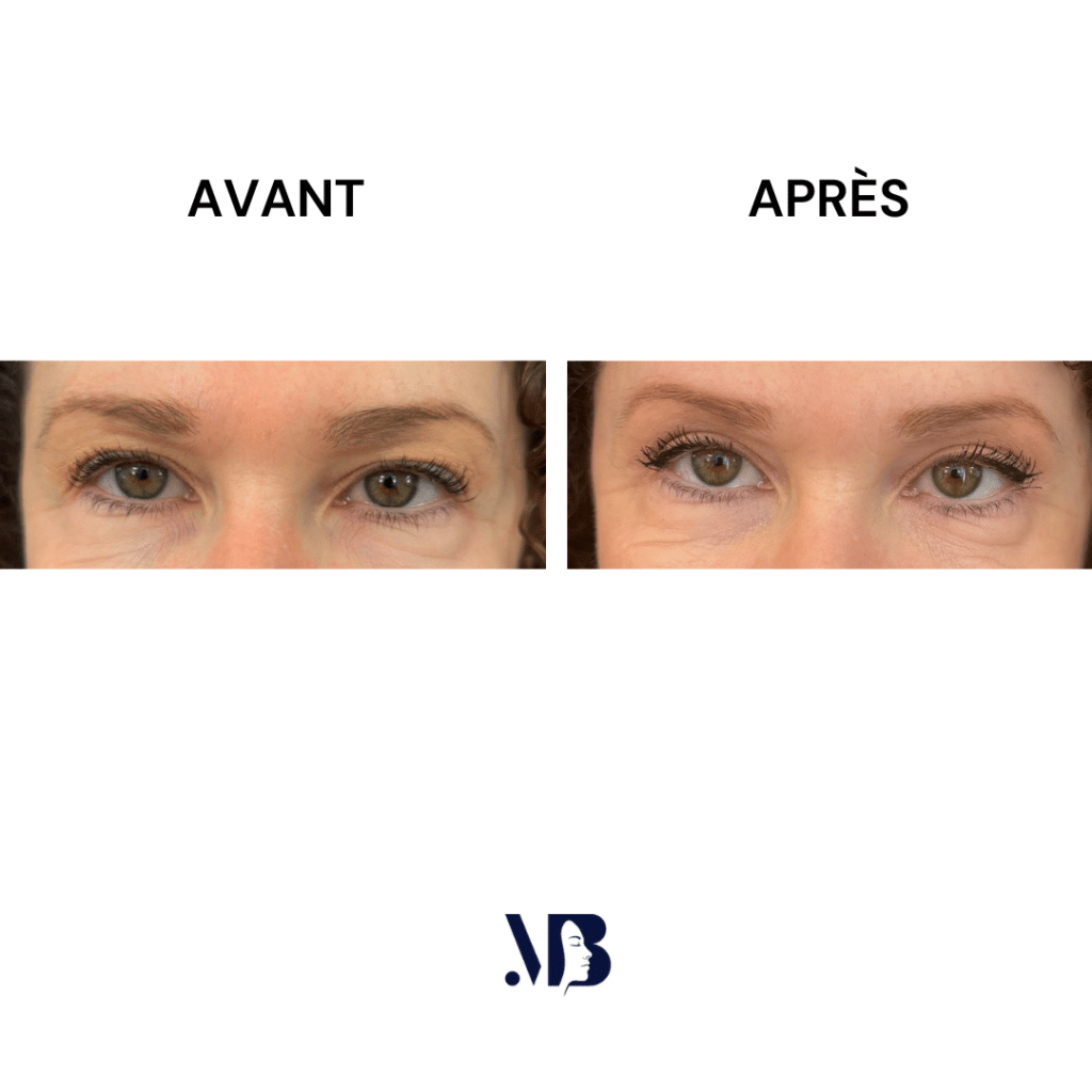 La blépharoplastie supérieure est la chirurgie esthétique des paupières tombante.