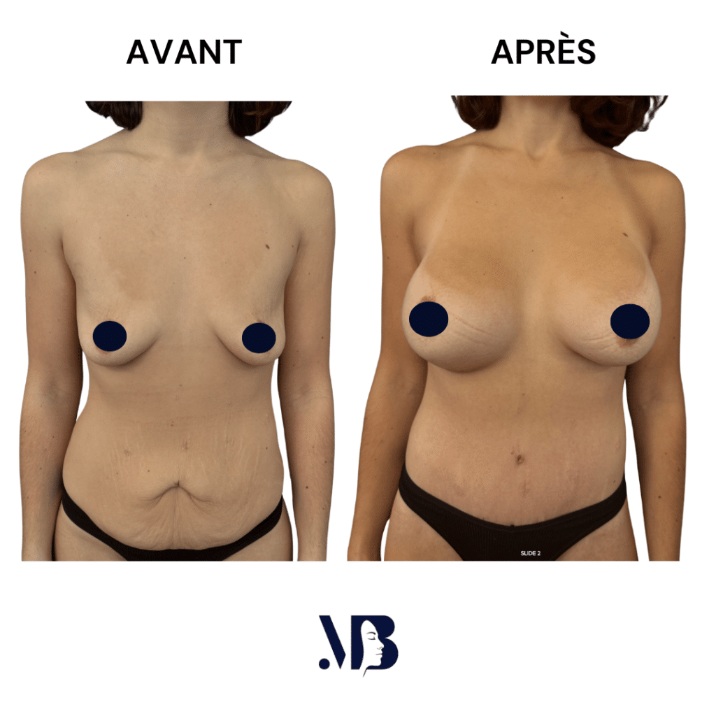 L'abdominoplastie ou plastie abdominal est un lifting du ventre qui permet de diminuer le volume de celui-ci.