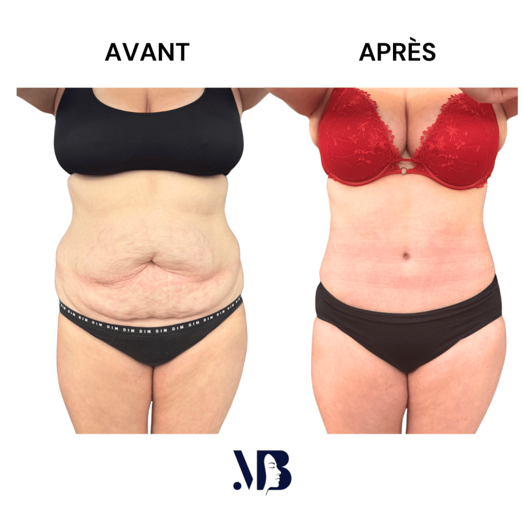 L'abdominoplastie ou plastie abdominal est un lifting du ventre qui permet de diminuer le volume de celui-ci.