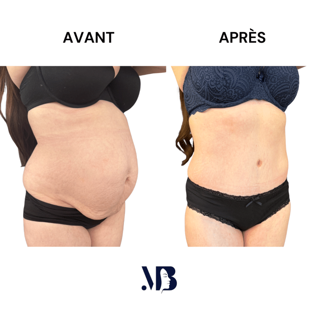 L'abdominoplastie ou plastie abdominal est un lifting du ventre qui permet de diminuer le volume de celui-ci.