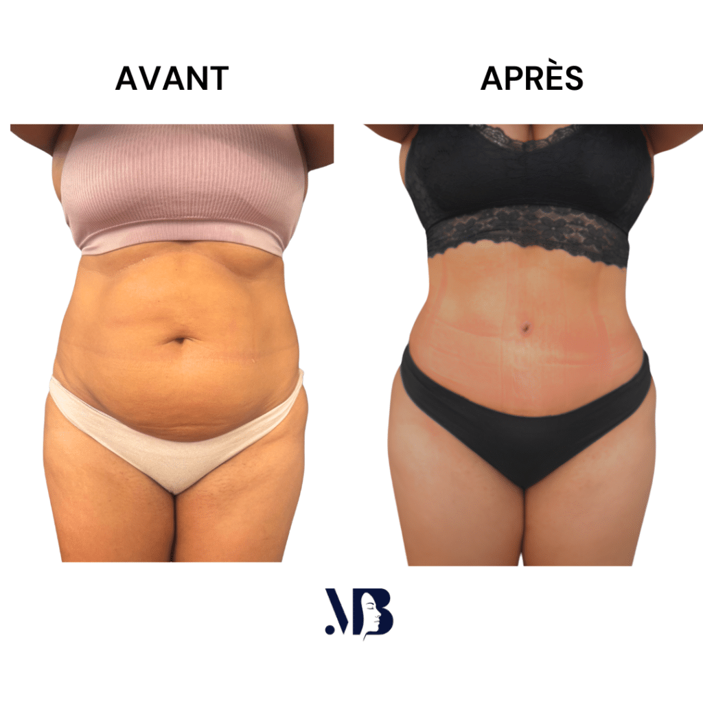 L'abdominoplastie ou plastie abdominal est un lifting du ventre qui permet de diminuer le volume de celui-ci.