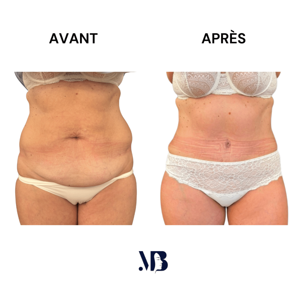 L'abdominoplastie ou plastie abdominal est un lifting du ventre qui permet de diminuer le volume de celui-ci.