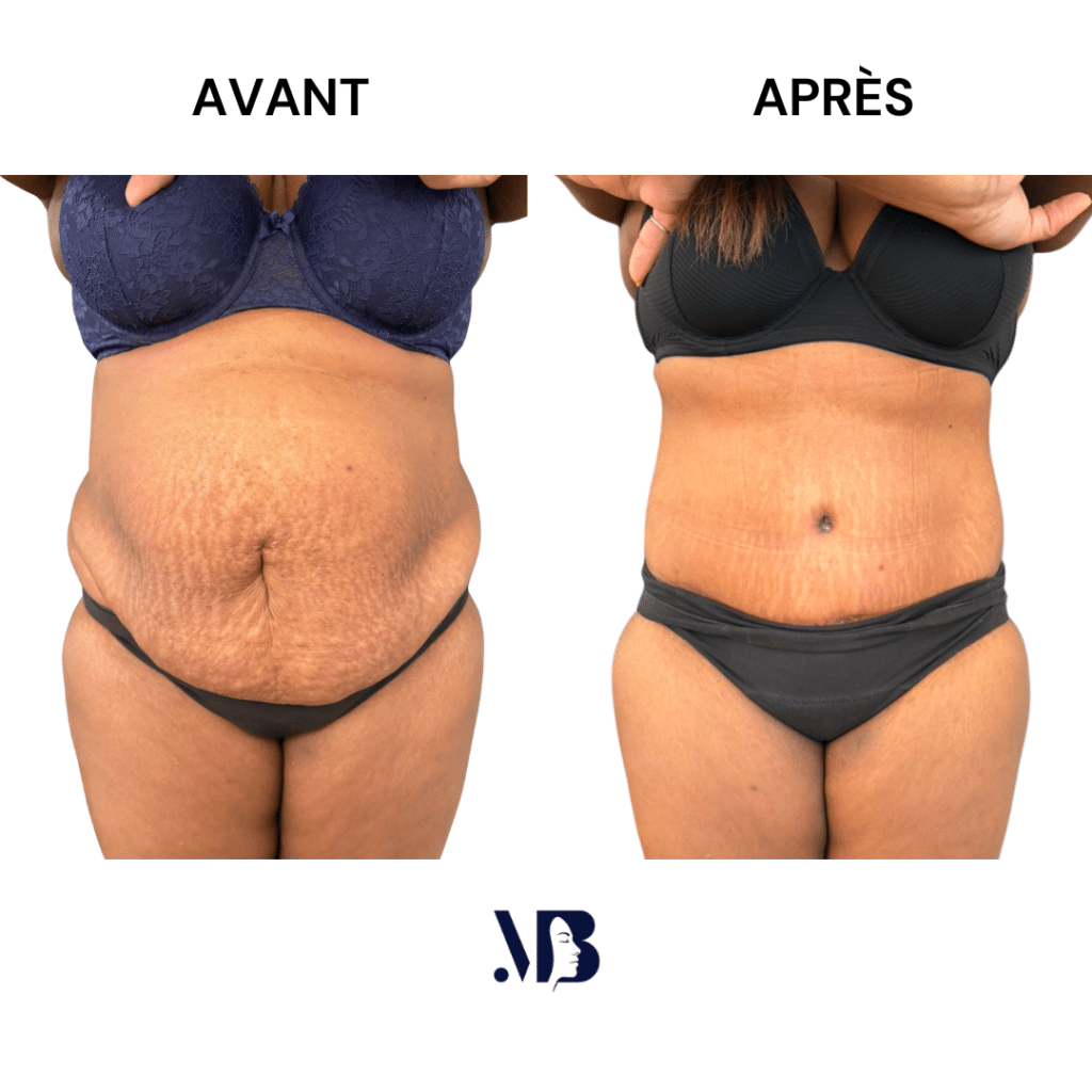 L'abdominoplastie ou plastie abdominal est un lifting du ventre qui permet de diminuer le volume de celui-ci.