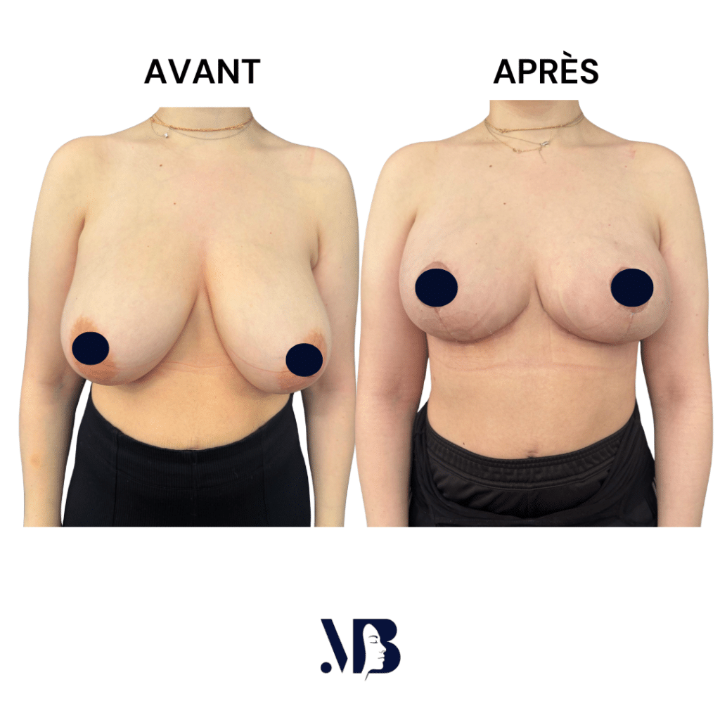 La réduction mammaire permet de diminuer le volume des seins par via une chirurgie plastique.