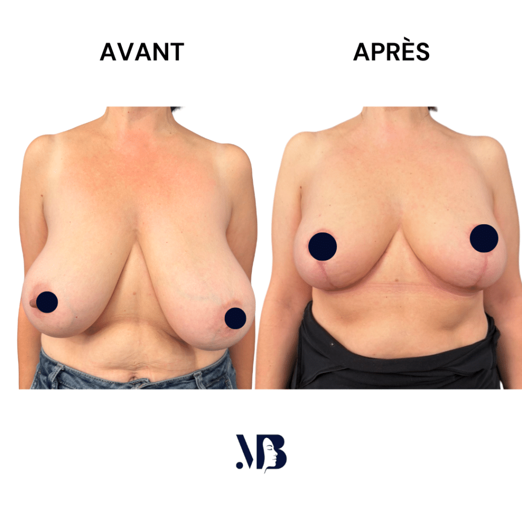 La réduction mammaire permet de diminuer le volume des seins par via une chirurgie plastique.