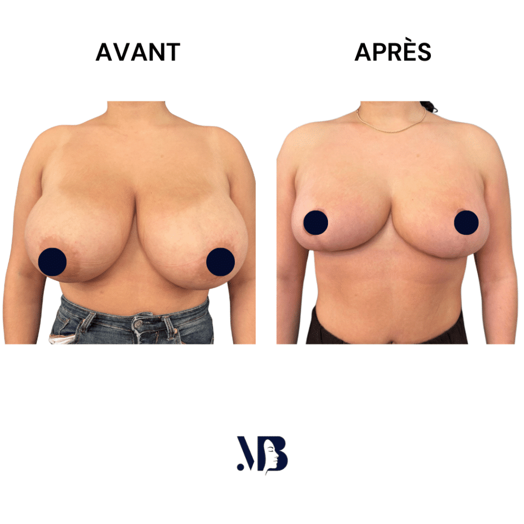 La réduction mammaire permet de diminuer le volume des seins par via une chirurgie plastique.