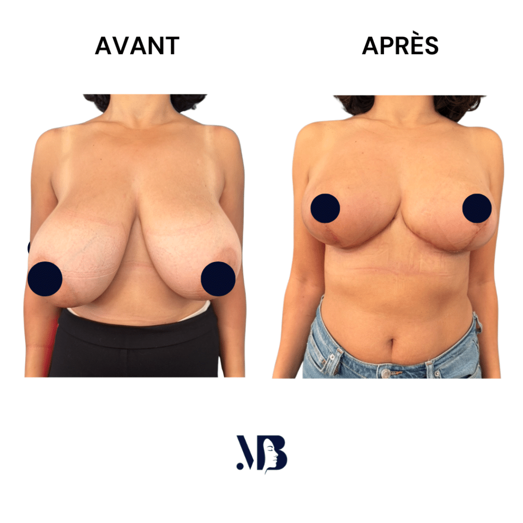 La réduction mammaire permet de diminuer le volume des seins par via une chirurgie plastique.