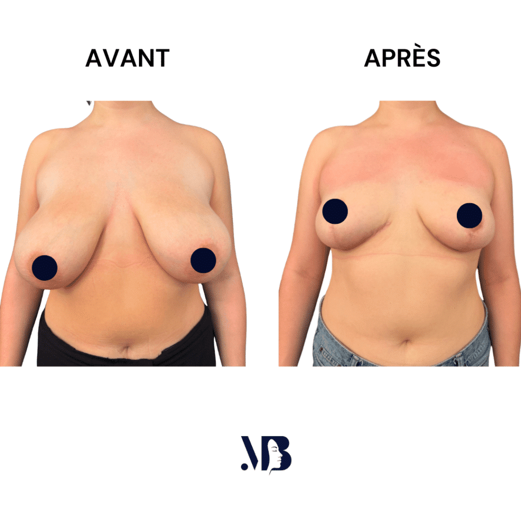 La réduction mammaire permet de diminuer le volume des seins par via une chirurgie plastique.