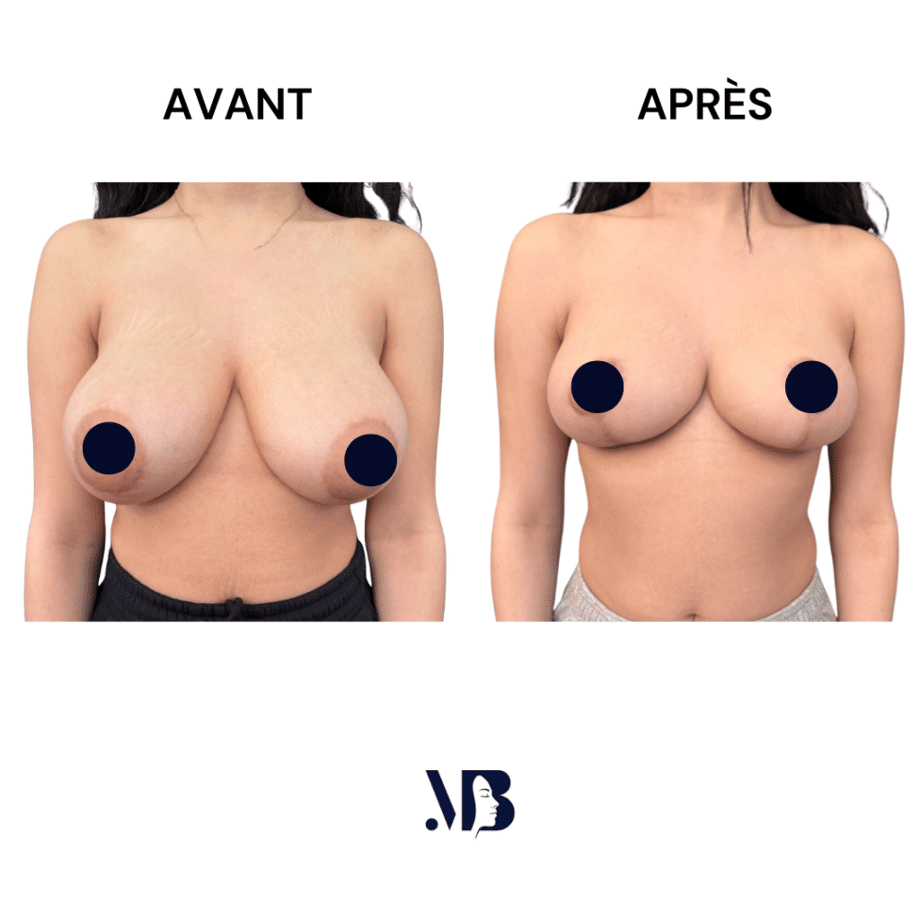 La réduction mammaire permet de diminuer le volume des seins par via une chirurgie plastique.