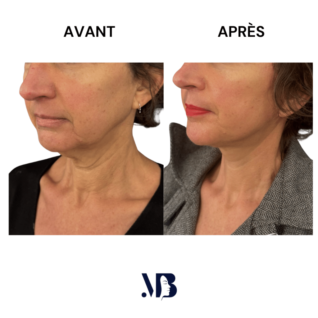 Le lifting du visage et du cou à Paris permet de retendre la peau du visage et du cou par la chirurgie de manière naturelle.