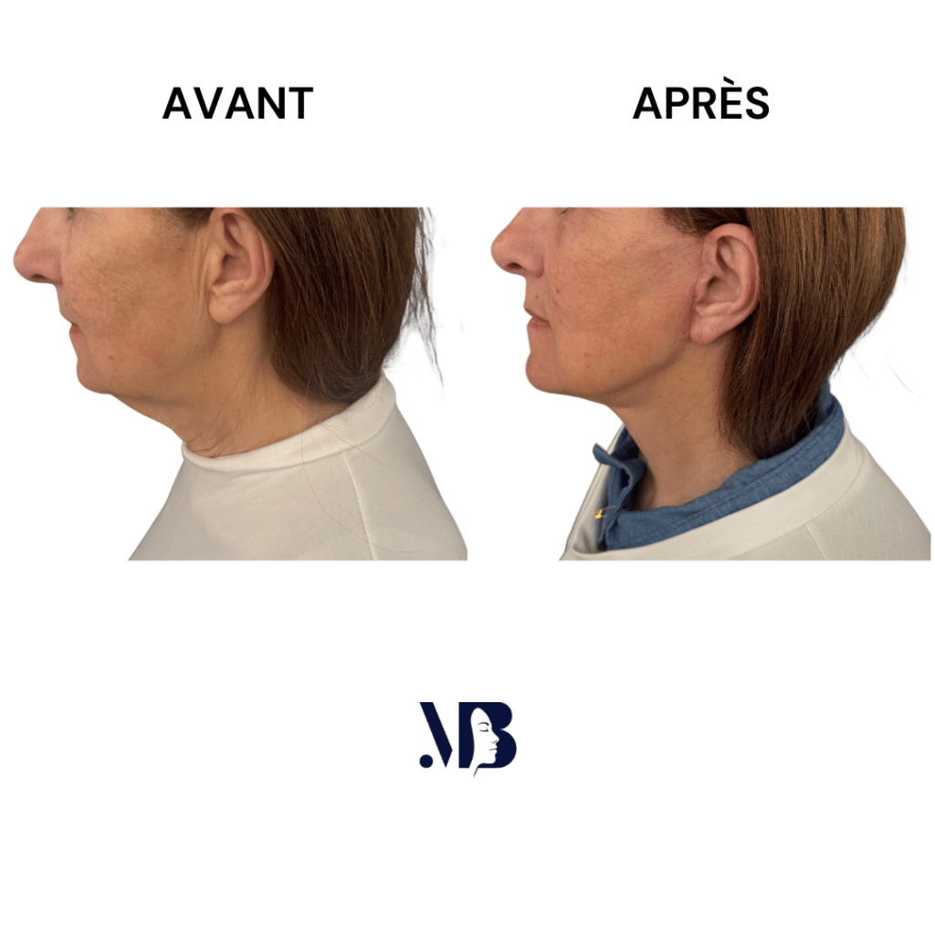 Le lifting du visage et du cou à Paris permet de retendre la peau du visage et du cou par la chirurgie de manière naturelle.