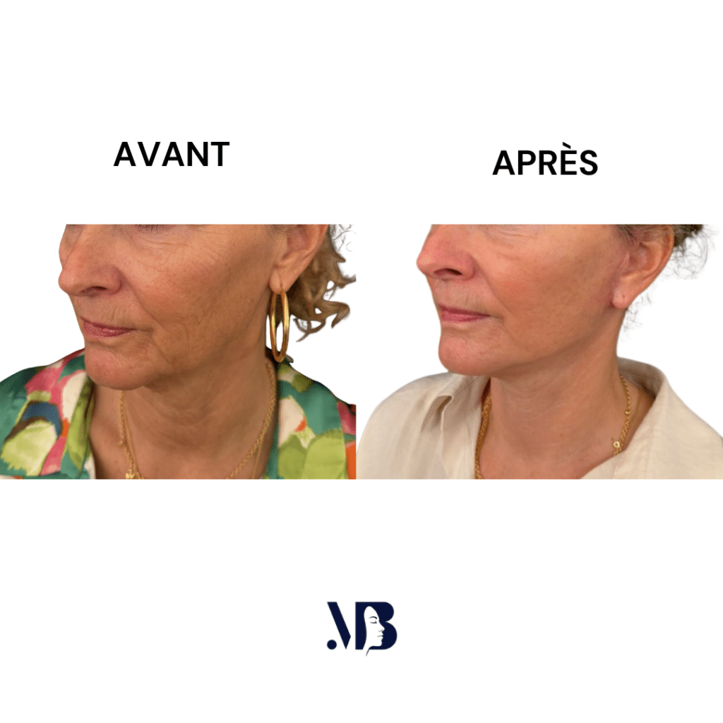Le lifting du visage et du cou à Paris permet de retendre la peau du visage et du cou par la chirurgie de manière naturelle.