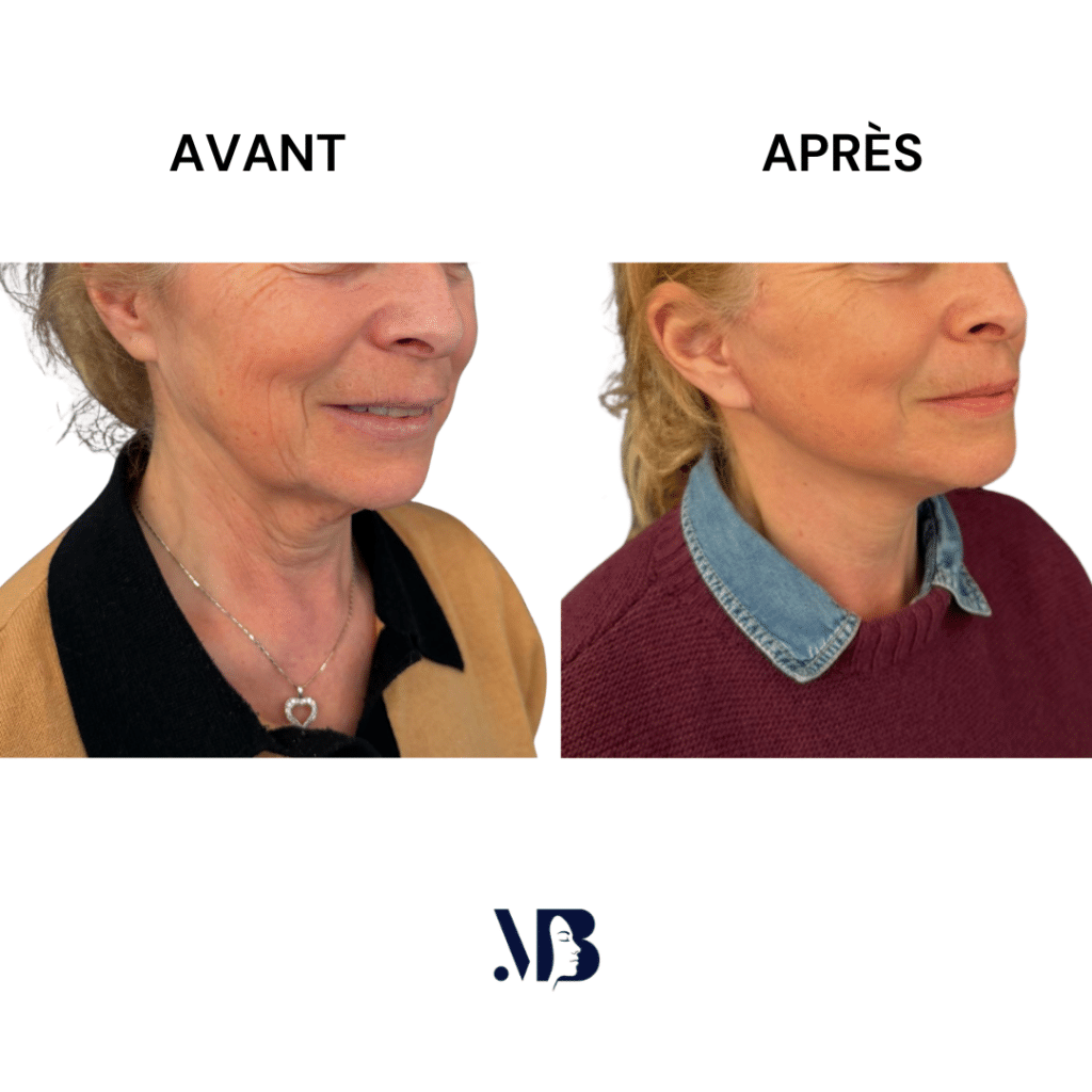 Le lifting du visage et du cou à Paris permet de retendre la peau du visage et du cou par la chirurgie de manière naturelle.
