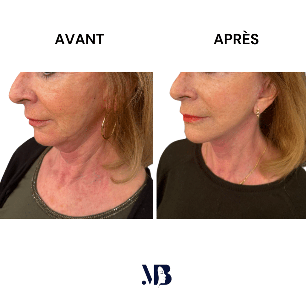 Le lifting du visage et du cou à Paris permet de retendre la peau du visage et du cou par la chirurgie de manière naturelle.