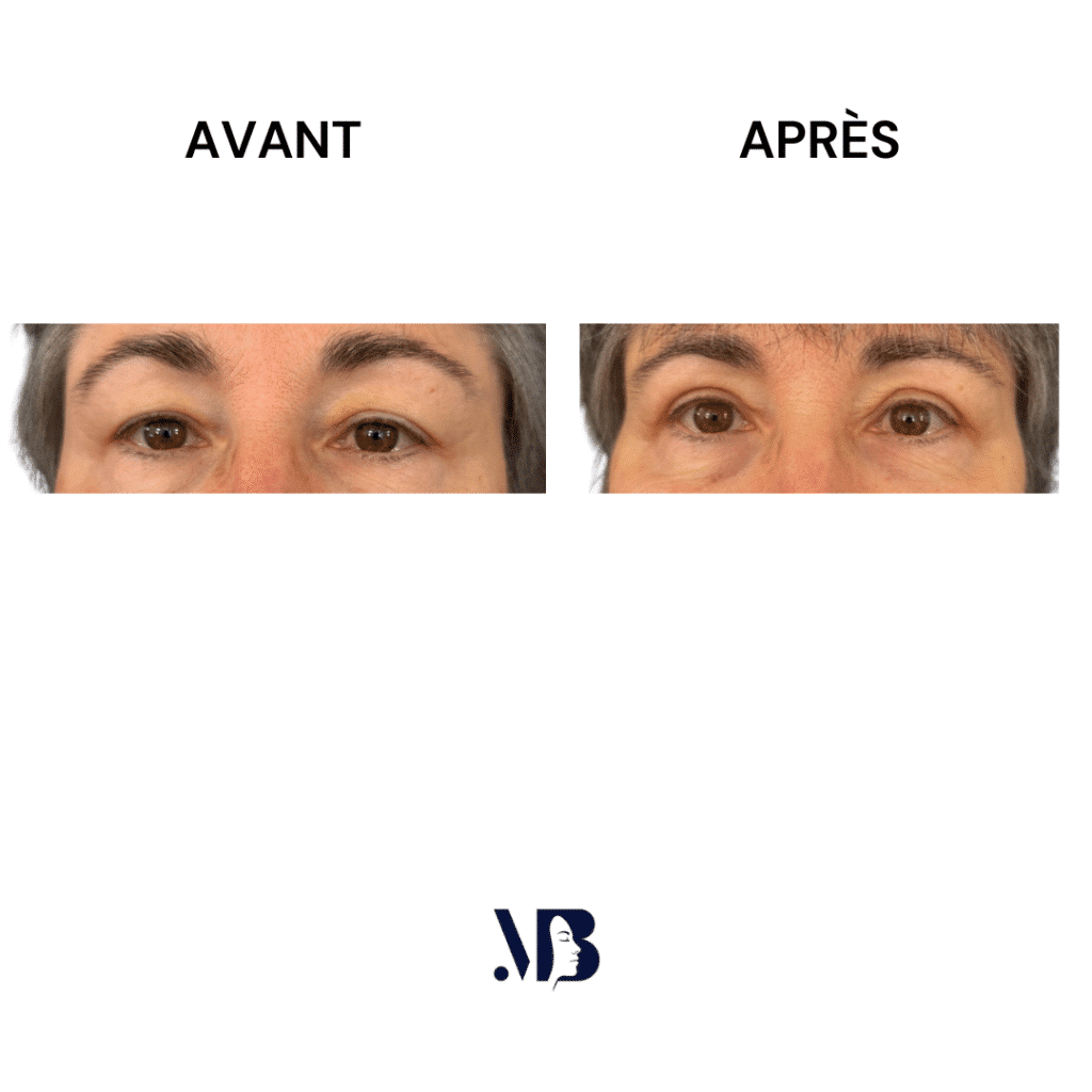 La blépharoplastie supérieure est la chirurgie esthétique des paupières tombante.