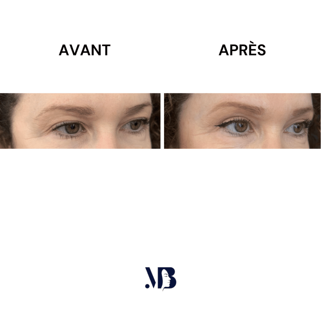 La blépharoplastie supérieure est la chirurgie esthétique des paupières tombante.