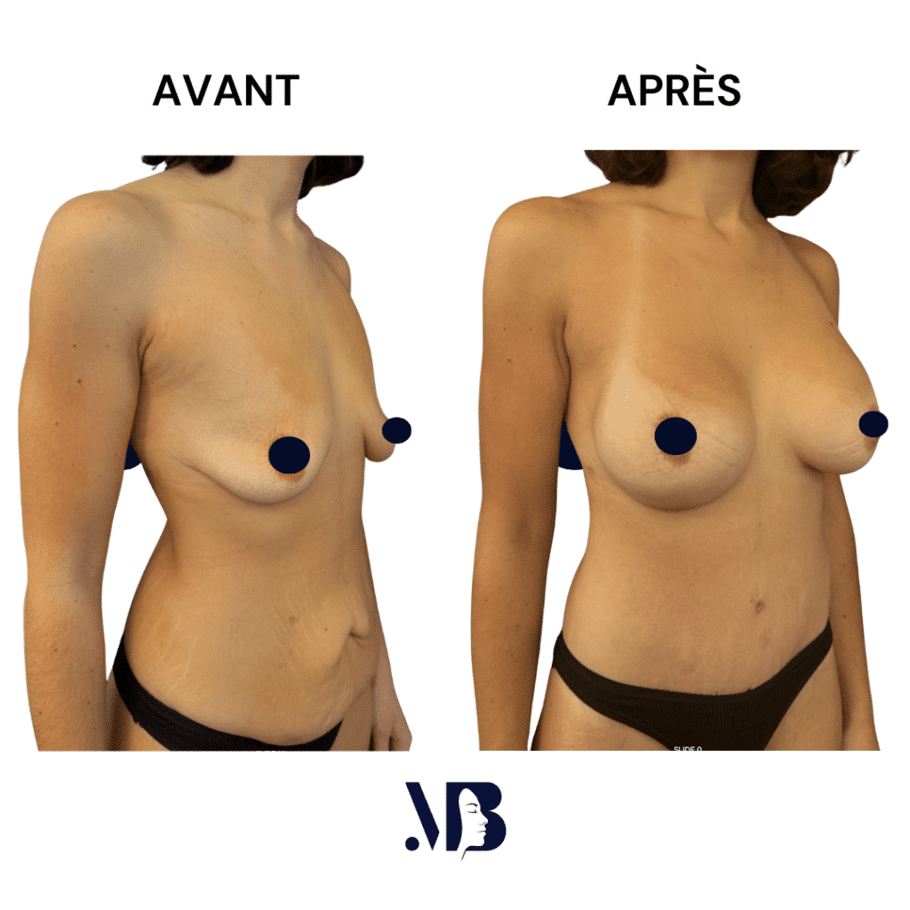 L'abdominoplastie ou plastie abdominal est un lifting du ventre qui permet de diminuer le volume de celui-ci.