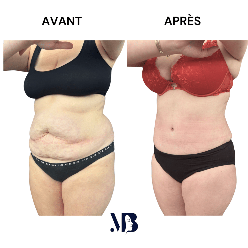 L'abdominoplastie ou plastie abdominal est un lifting du ventre qui permet de diminuer le volume de celui-ci.