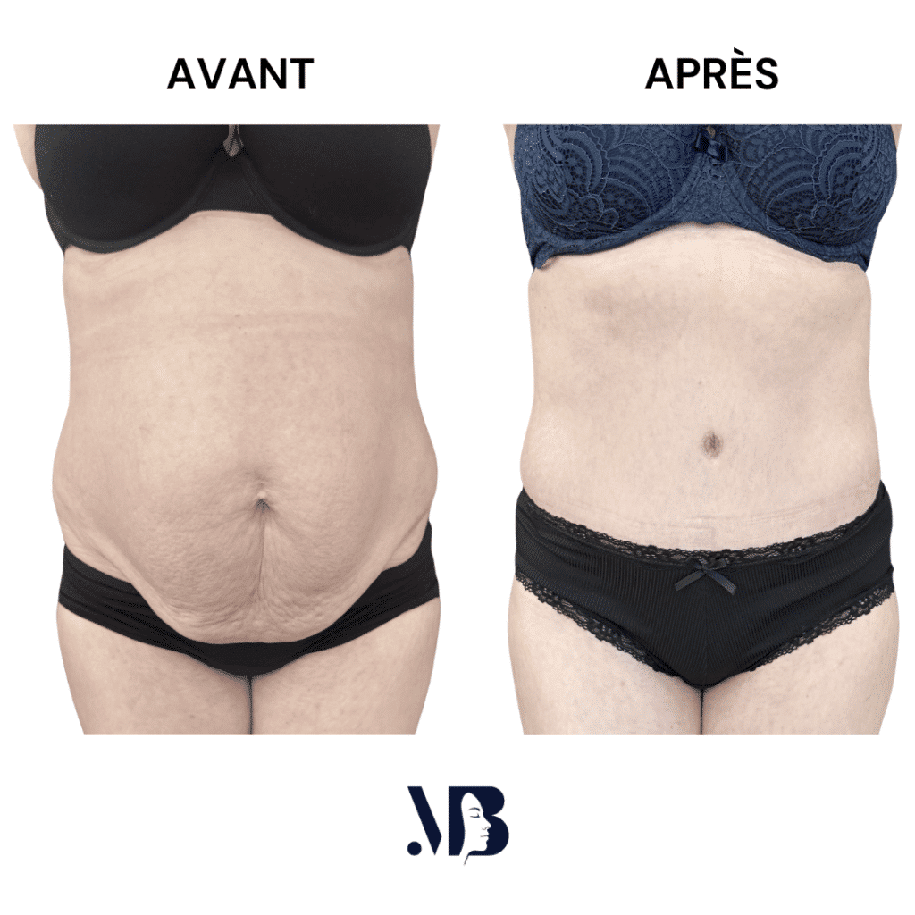 L'abdominoplastie ou plastie abdominal est un lifting du ventre qui permet de diminuer le volume de celui-ci.