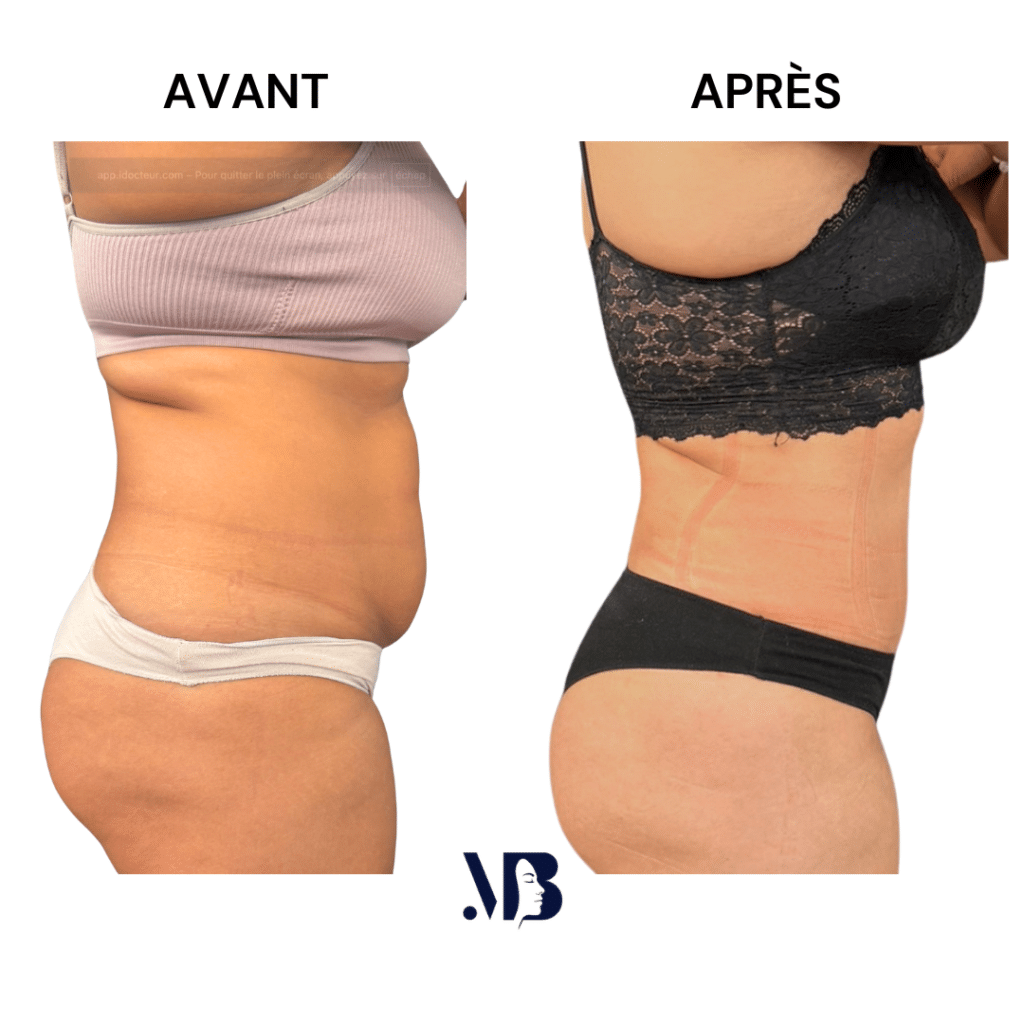 L'abdominoplastie ou plastie abdominal est un lifting du ventre qui permet de diminuer le volume de celui-ci.