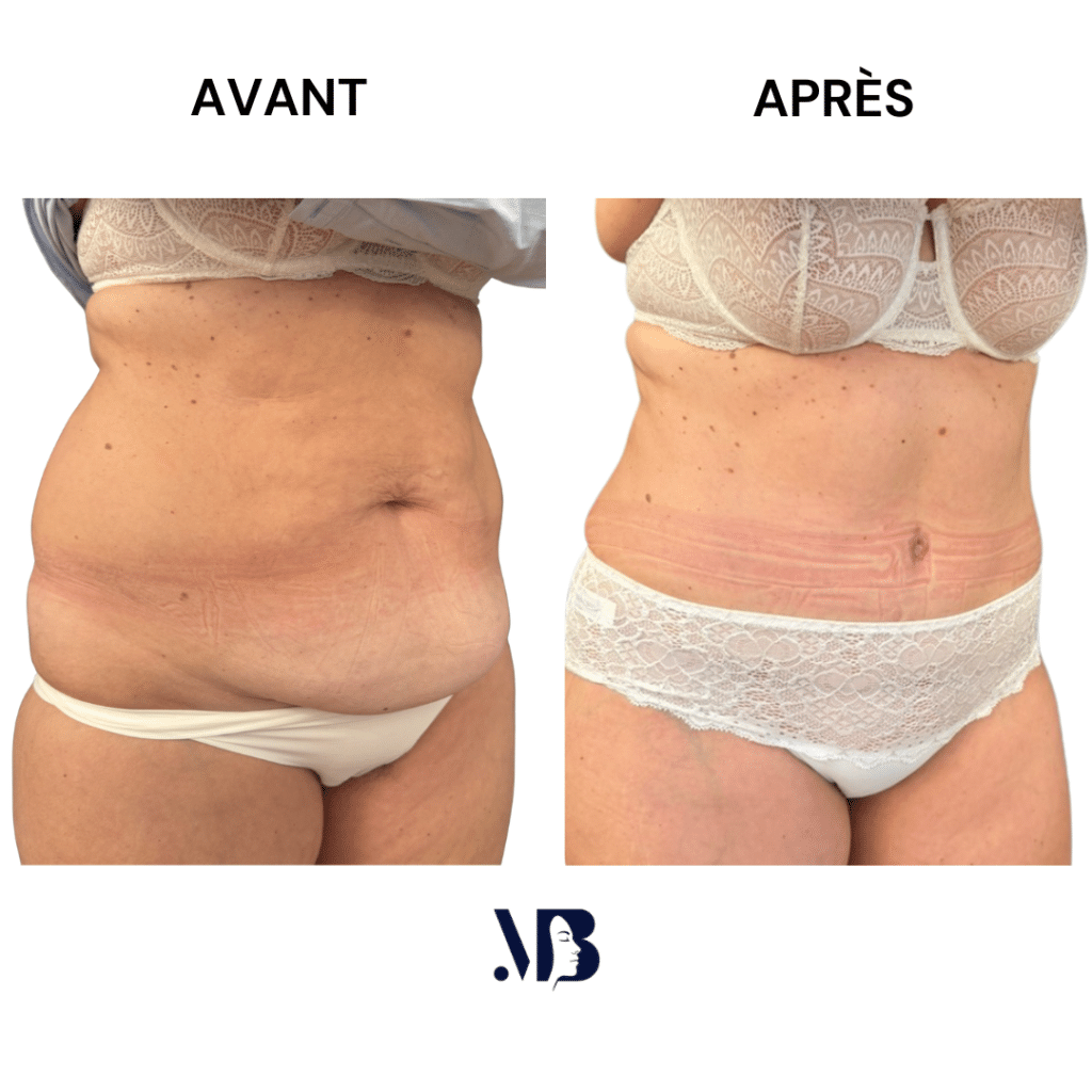 L'abdominoplastie ou plastie abdominal est un lifting du ventre qui permet de diminuer le volume de celui-ci.