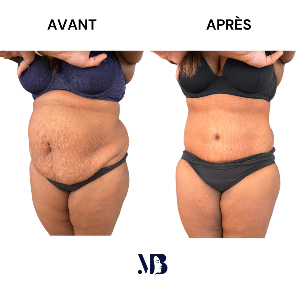 L'abdominoplastie ou plastie abdominal est un lifting du ventre qui permet de diminuer le volume de celui-ci.