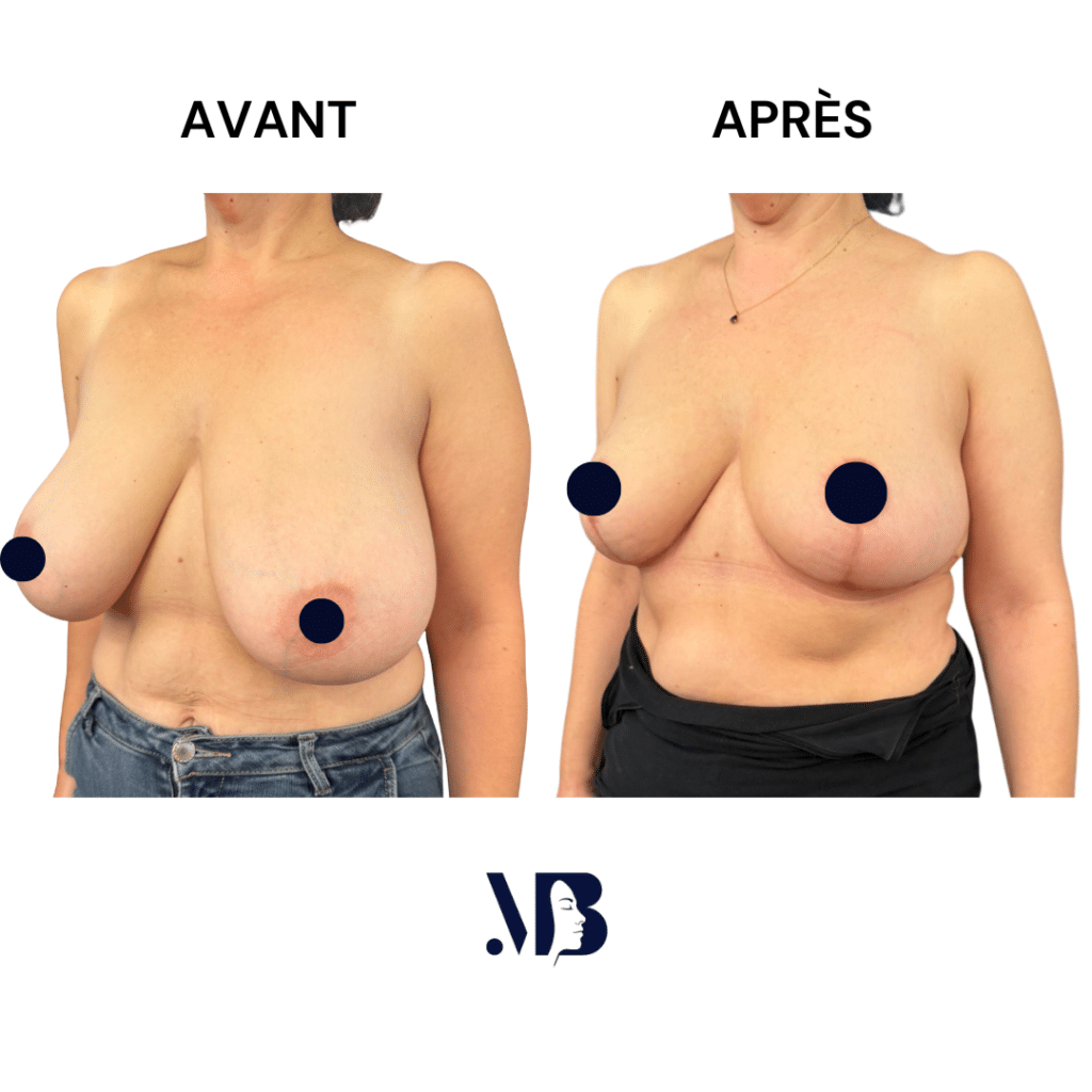 La réduction mammaire permet de diminuer le volume des seins par via une chirurgie plastique.