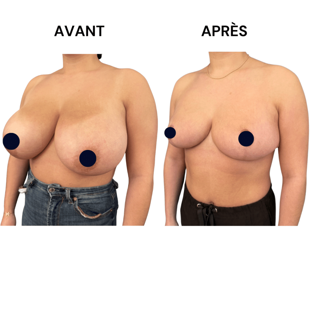 La réduction mammaire permet de diminuer le volume des seins par via une chirurgie plastique.
