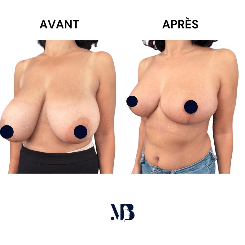 La réduction mammaire permet de diminuer le volume des seins par via une chirurgie plastique.