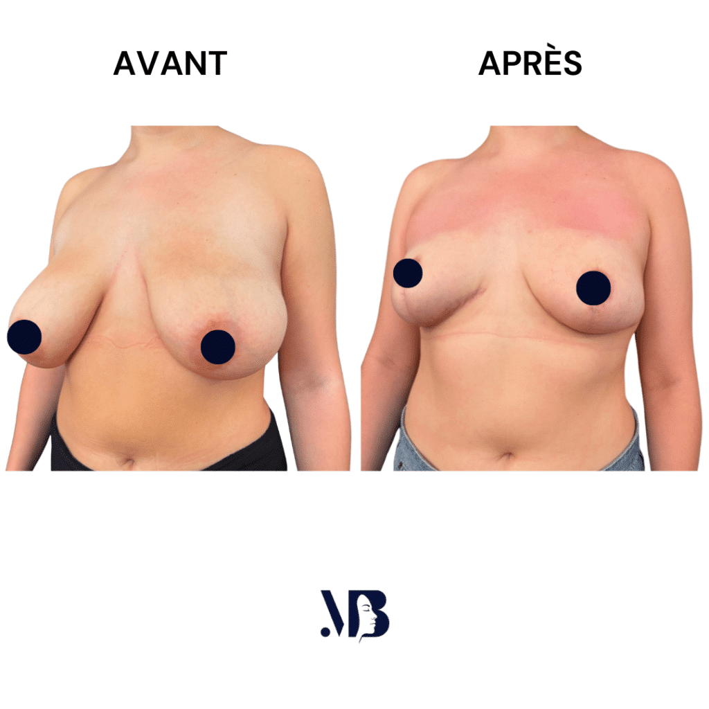 La réduction mammaire permet de diminuer le volume des seins par via une chirurgie plastique.