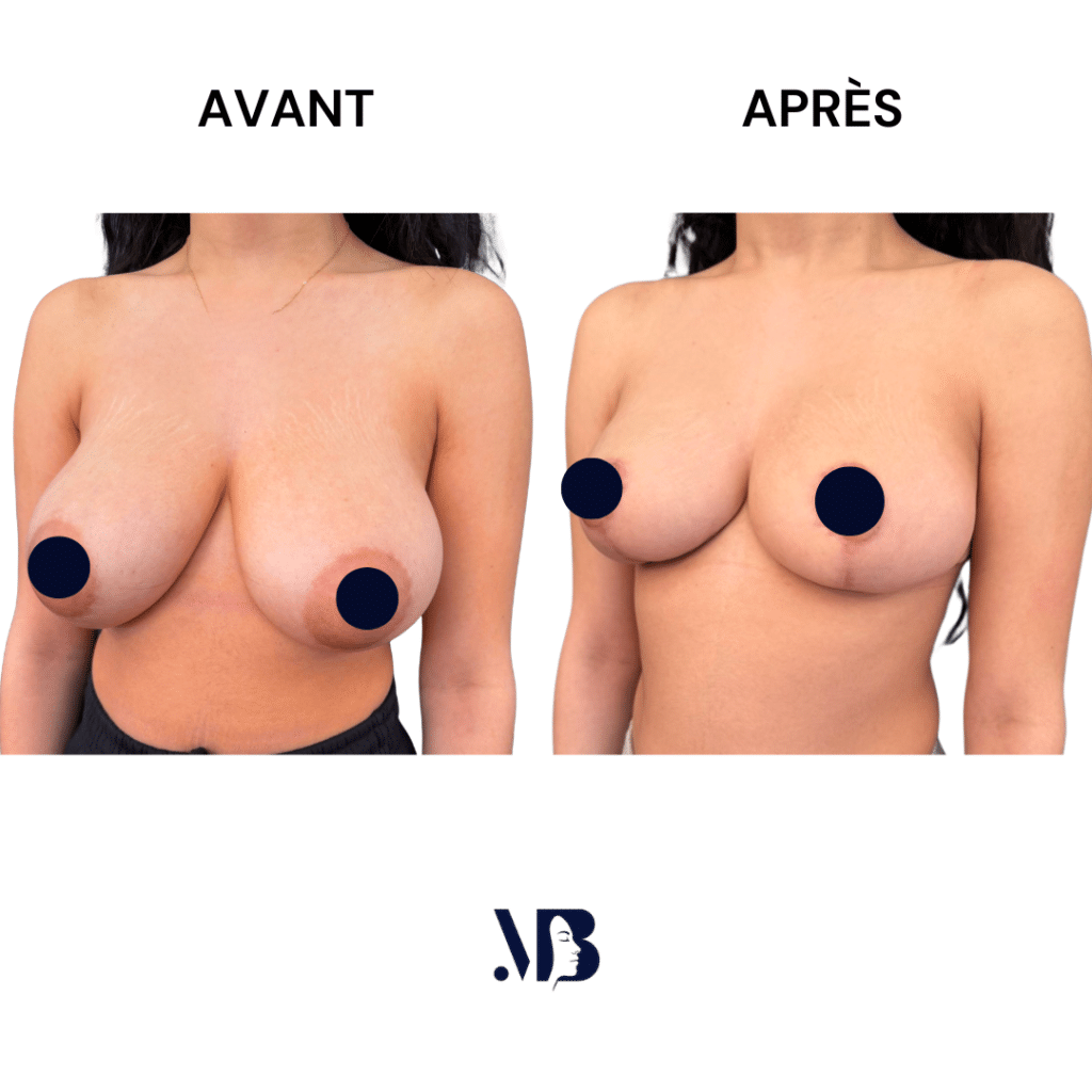 La réduction mammaire permet de diminuer le volume des seins par via une chirurgie plastique.