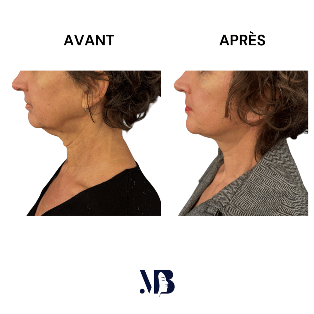 Le lifting du visage et du cou à Paris permet de retendre la peau du visage et du cou par la chirurgie de manière naturelle.