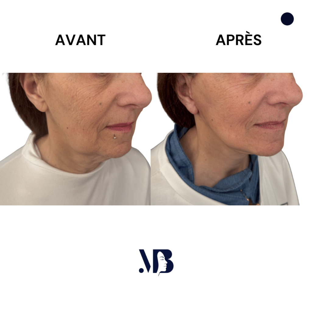 Le lifting du visage et du cou à Paris permet de retendre la peau du visage et du cou par la chirurgie de manière naturelle.