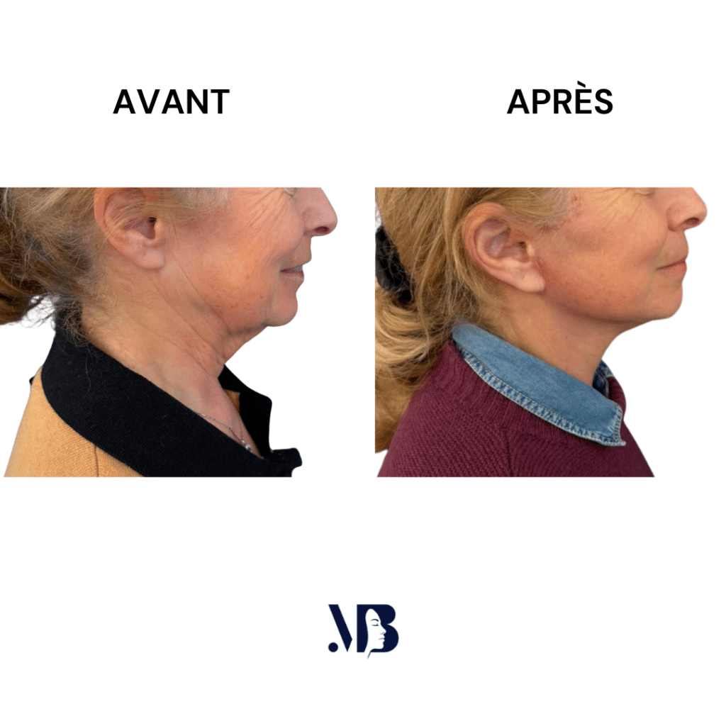 Le lifting du visage et du cou à Paris permet de retendre la peau du visage et du cou par la chirurgie de manière naturelle.