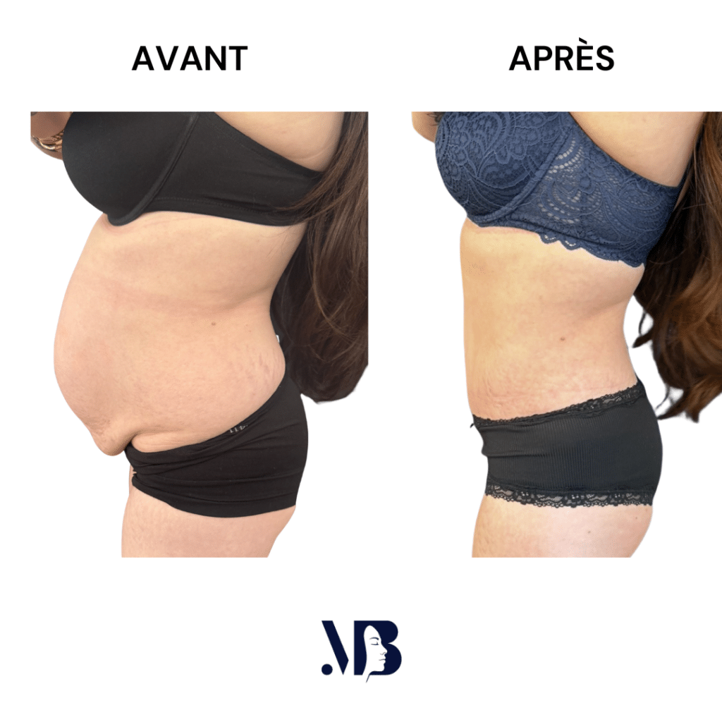 L'abdominoplastie ou plastie abdominal est un lifting du ventre qui permet de diminuer le volume de celui-ci.