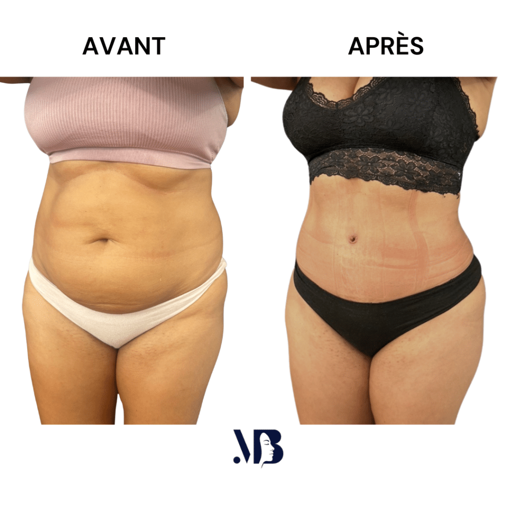 L'abdominoplastie ou plastie abdominal est un lifting du ventre qui permet de diminuer le volume de celui-ci.