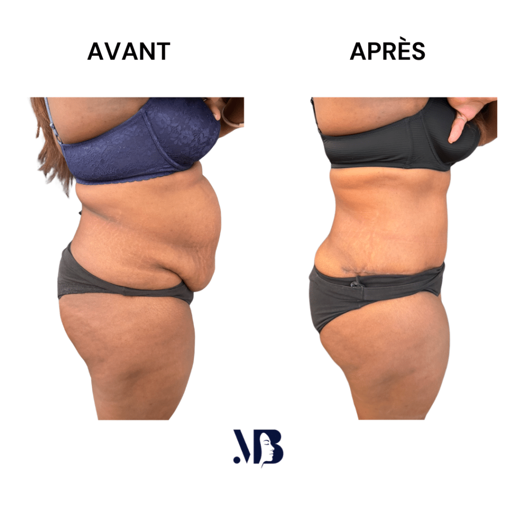 L'abdominoplastie ou plastie abdominal est un lifting du ventre qui permet de diminuer le volume de celui-ci.
