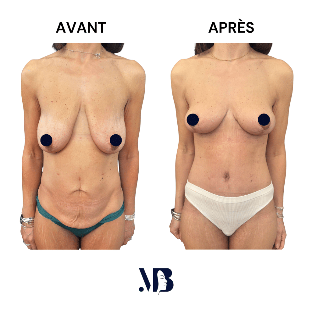 La chirurgie esthétique du sein et du ventre après grossesse est le mommy makeover . Cela permet de remonter les seins après grossesse et de retendre la peau du ventre endommagée par la grossesse.