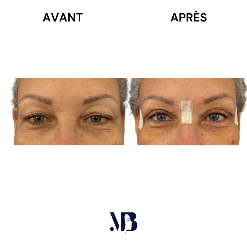 La blépharoplastie supérieure est la chirurgie esthétique des paupières tombante.