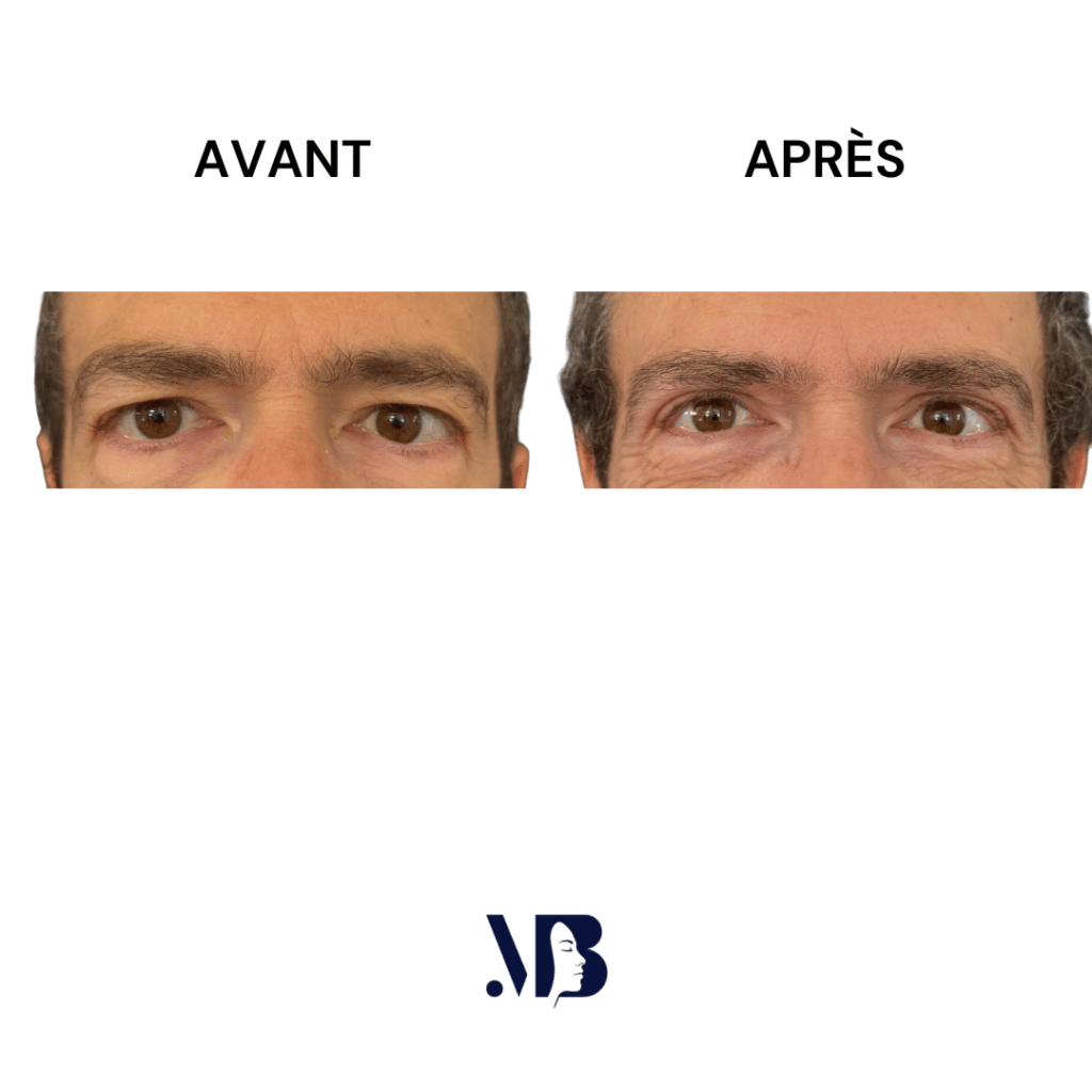 La blépharoplastie supérieure est la chirurgie esthétique des paupières tombante.