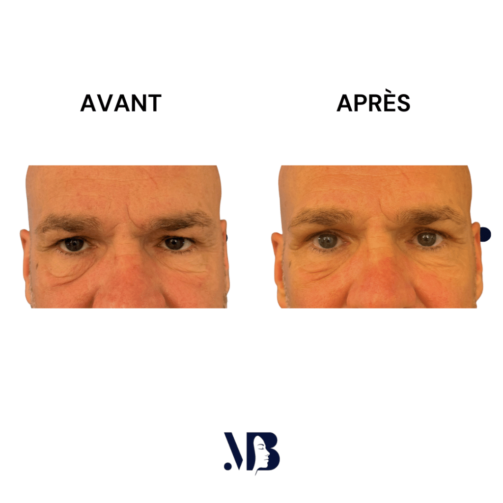 La blépharoplastie supérieure est la chirurgie esthétique des paupières tombante.