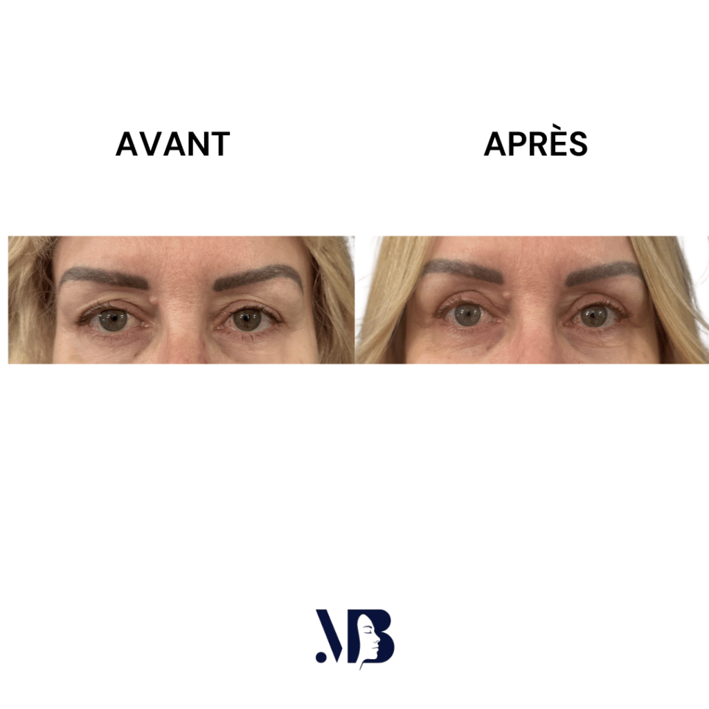 La blépharoplastie supérieure est la chirurgie esthétique des paupières tombante.