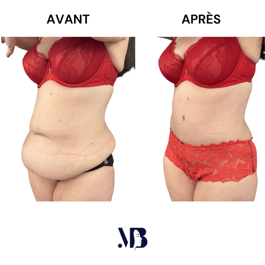 L'abdominoplastie ou plastie abdominal est un lifting du ventre qui permet de diminuer le volume de celui-ci.