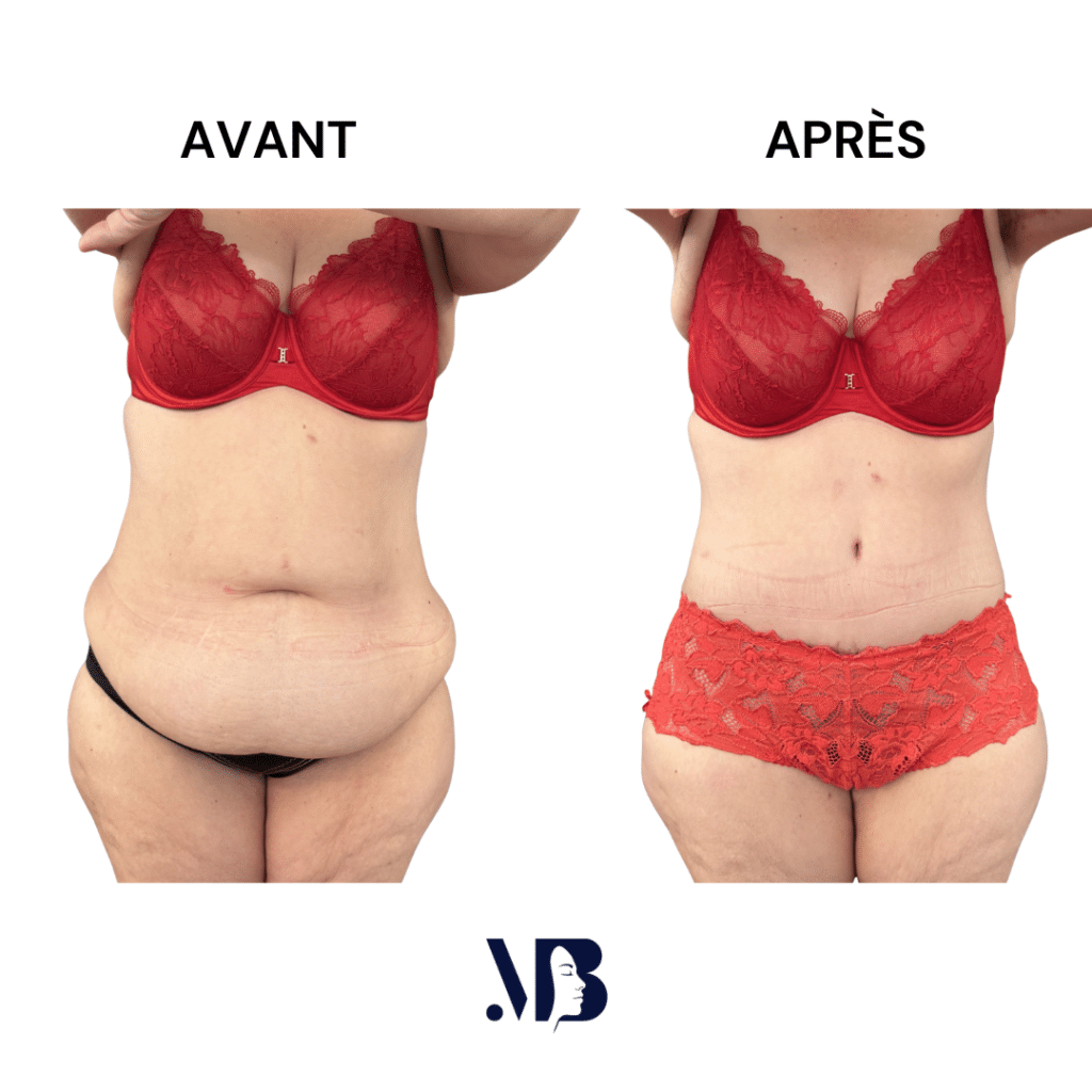 L'abdominoplastie ou plastie abdominal est un lifting du ventre qui permet de diminuer le volume de celui-ci.