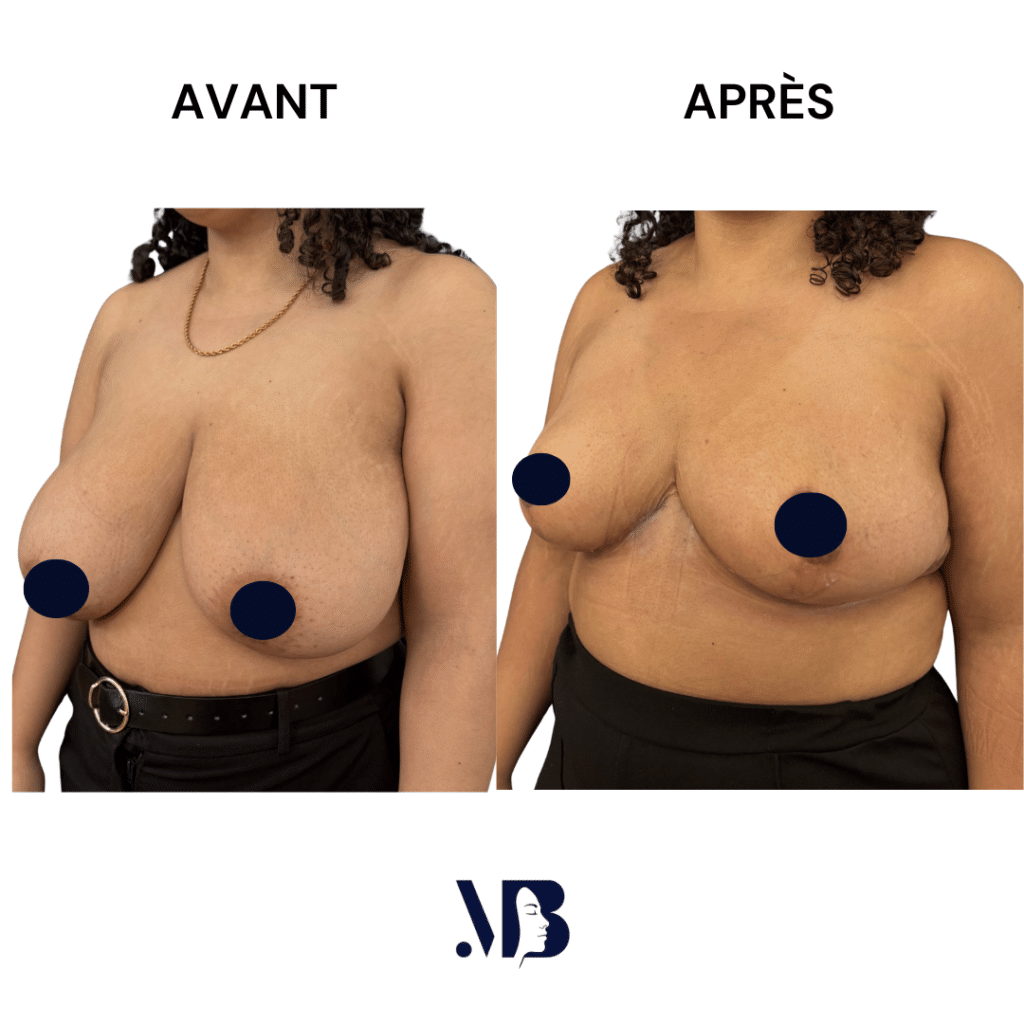 La réduction mammaire permet de diminuer le volume des seins par via une chirurgie plastique.